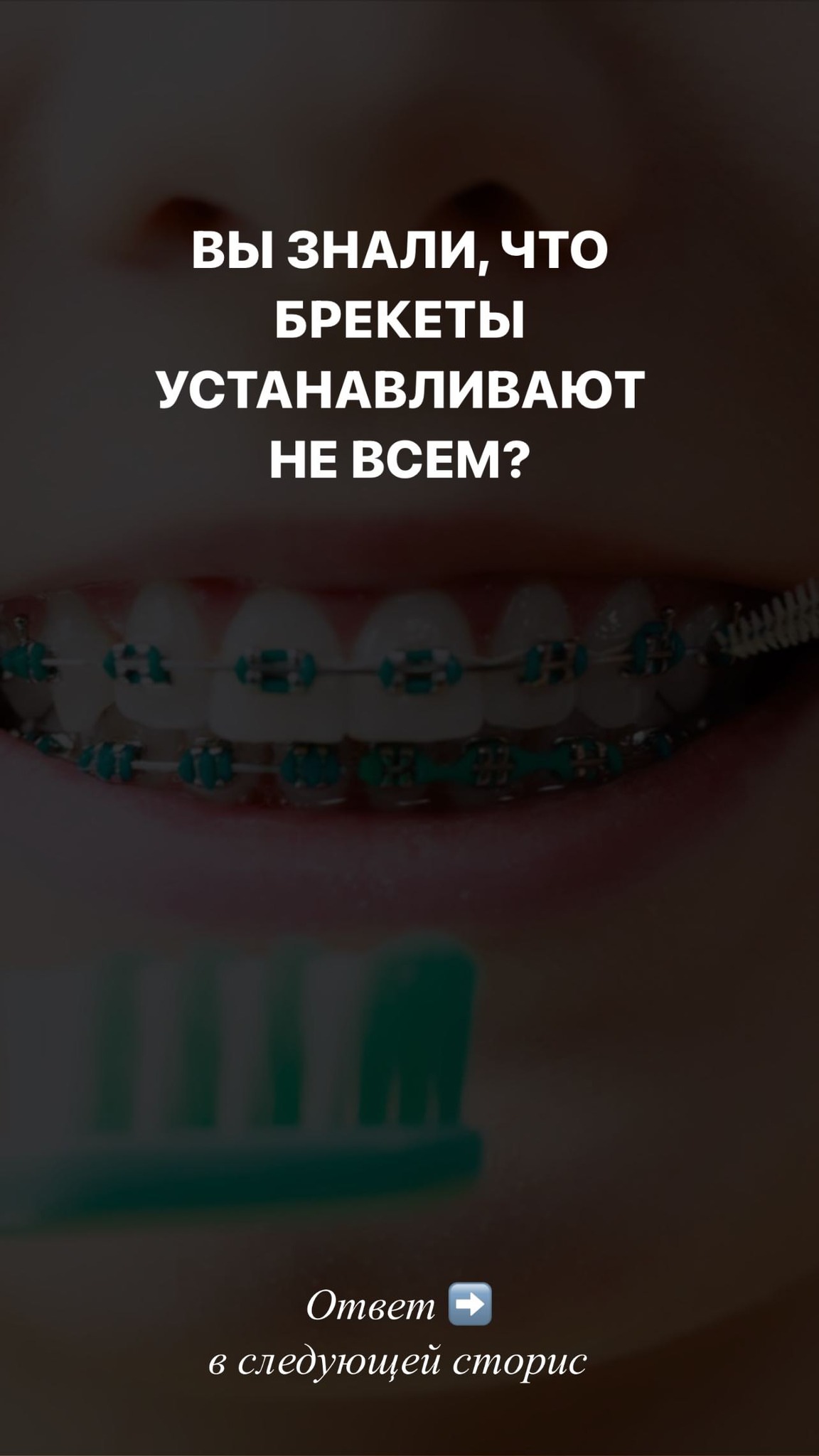 Брекеты Ош BioBrace 2