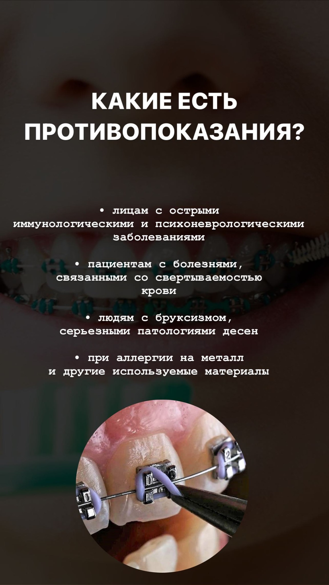 Ортодонтия брекеты Ош