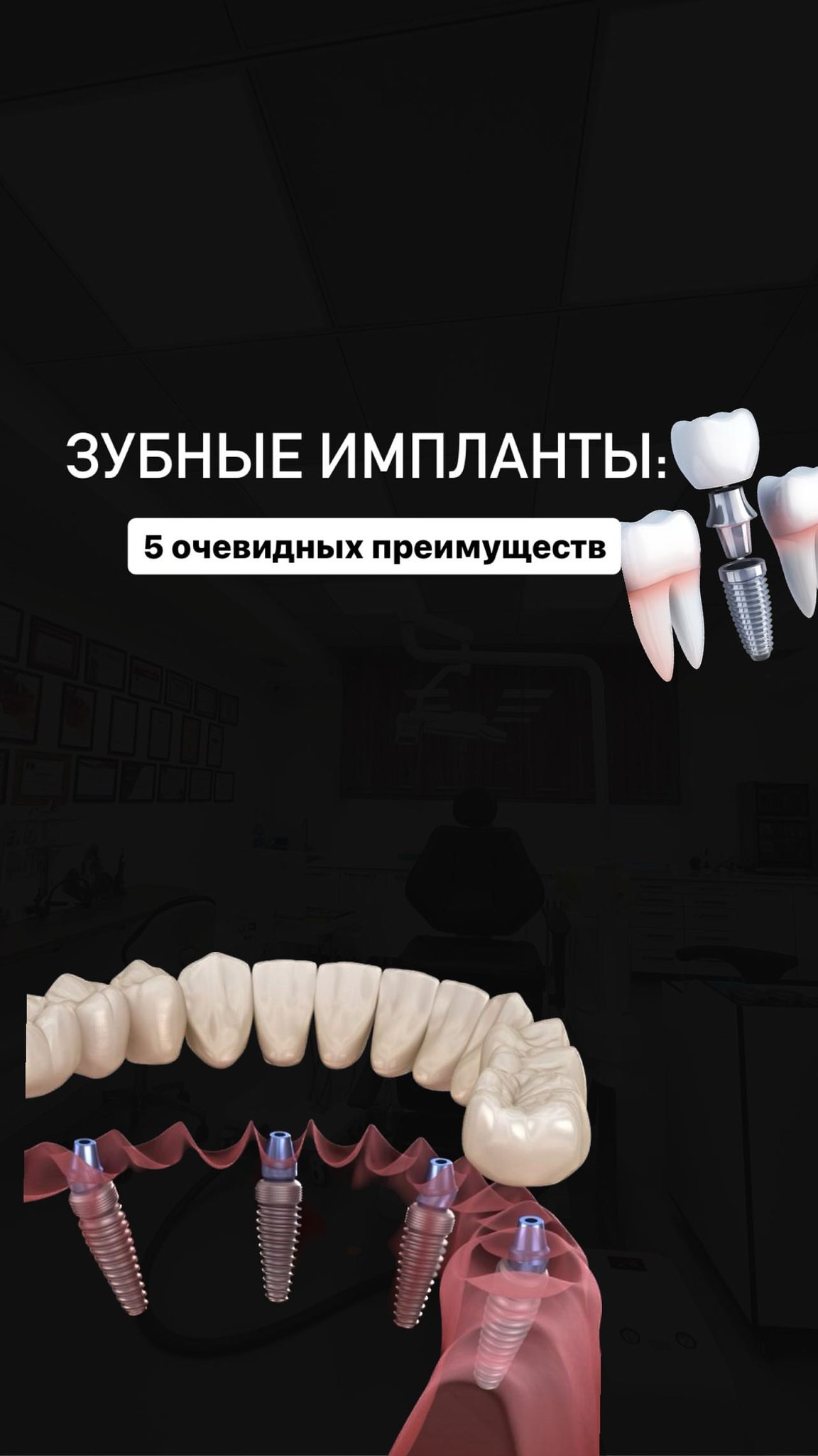 Имплантация