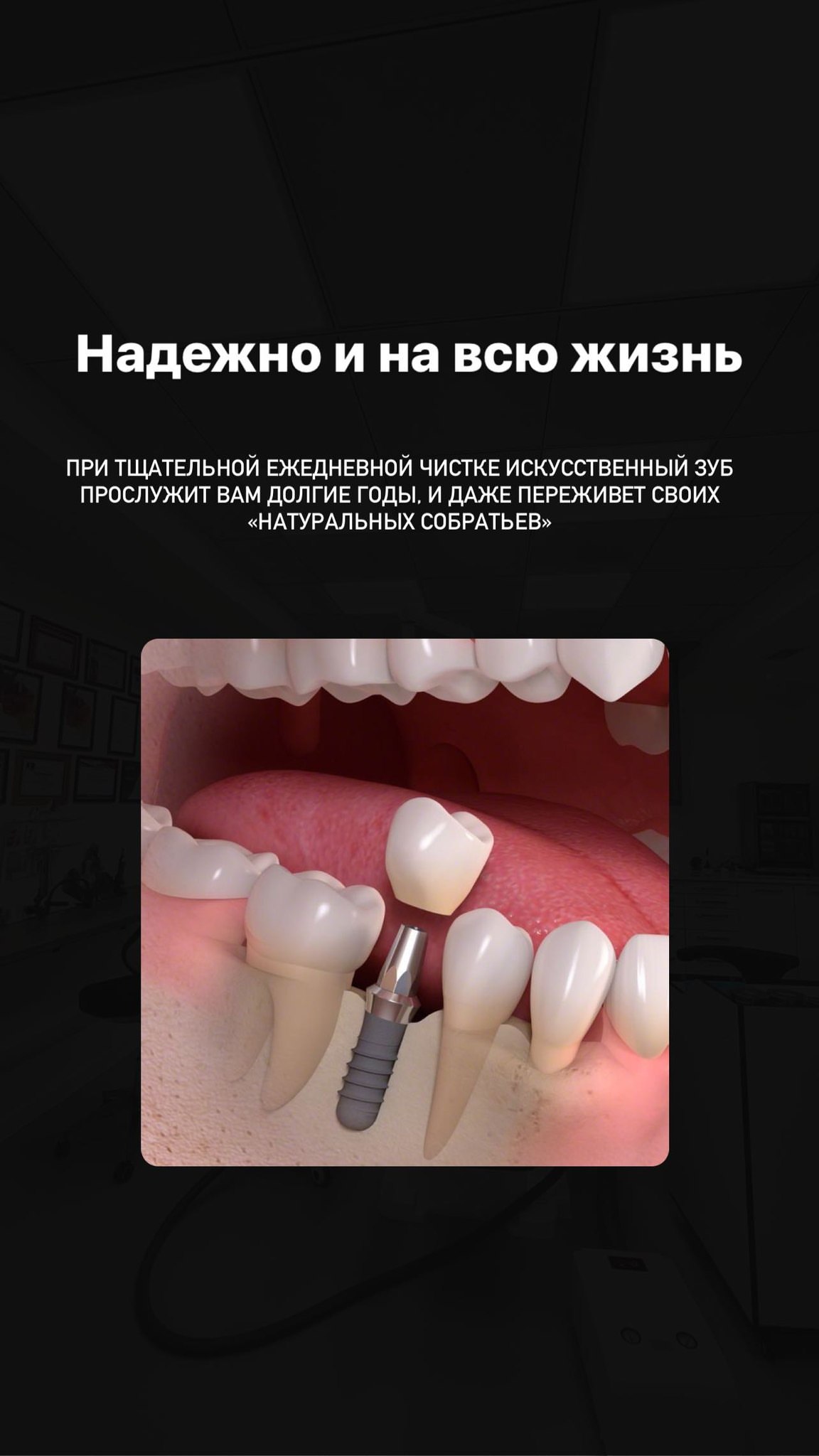 Имплантация