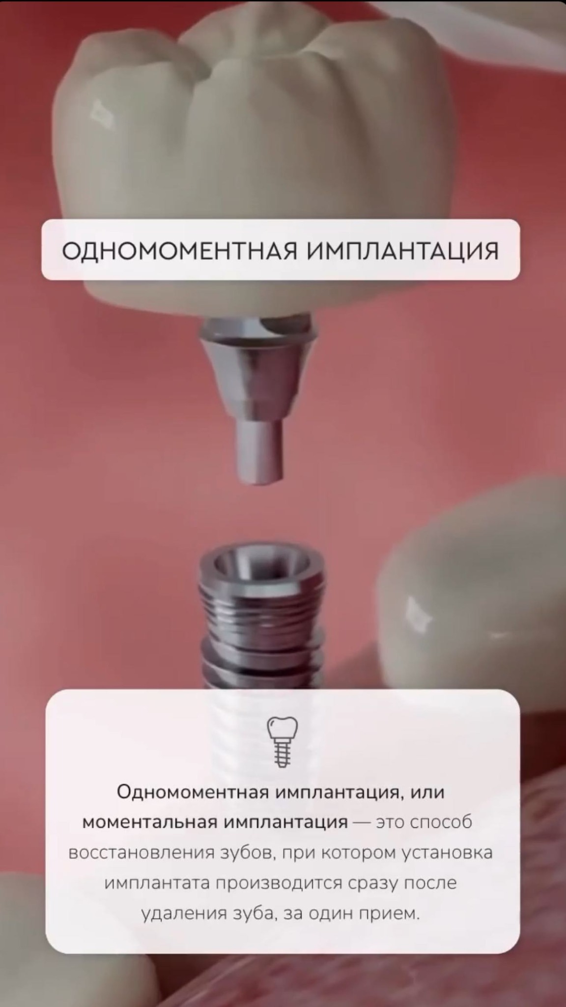 Имплант кейс