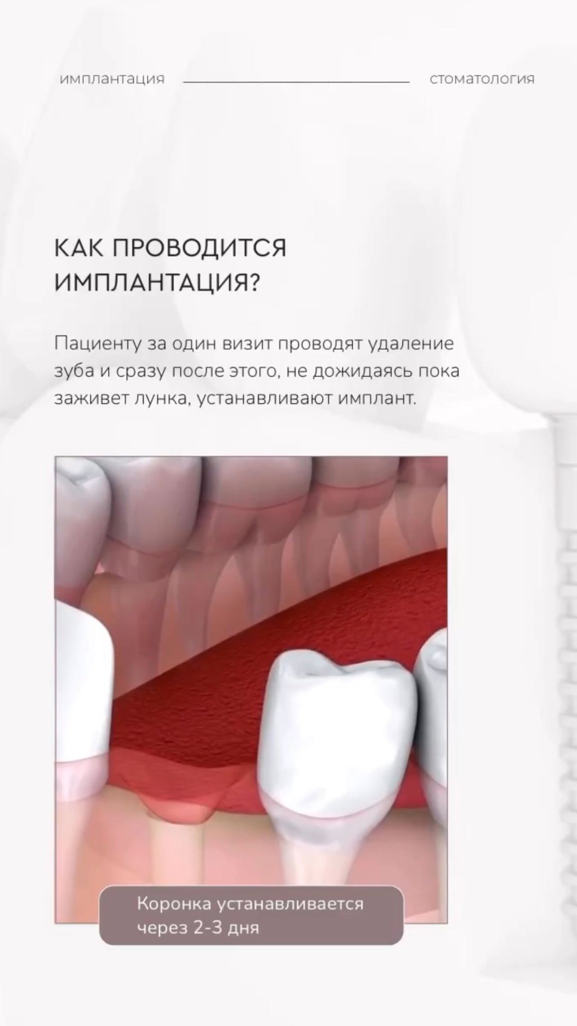 Имплантация зубов клиника Ош